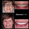 Vanha nainen hampaiden valkaisu ennen ja jälkeen kuvia - Teeth Whitening Diamond Smile