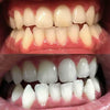 Kokemuksia Diamond Smile Teeth Bleaching Power+ Puhelimen valkaisevasta suukappaleesta - suu ennen ja jälkeen kuva valkoisista hampaista