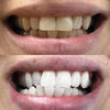Hampaiden valkaisu Foam - Kosmeettinen hampaiden valkaisu kotona
