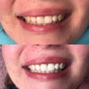 Hampaiden valkaisu - Hampaiden valkaisugeeli ja hampaiden valkaisusetti