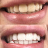 Hampaiden valkaisu - Hampaiden valkaisusetti Diamond Smilesta